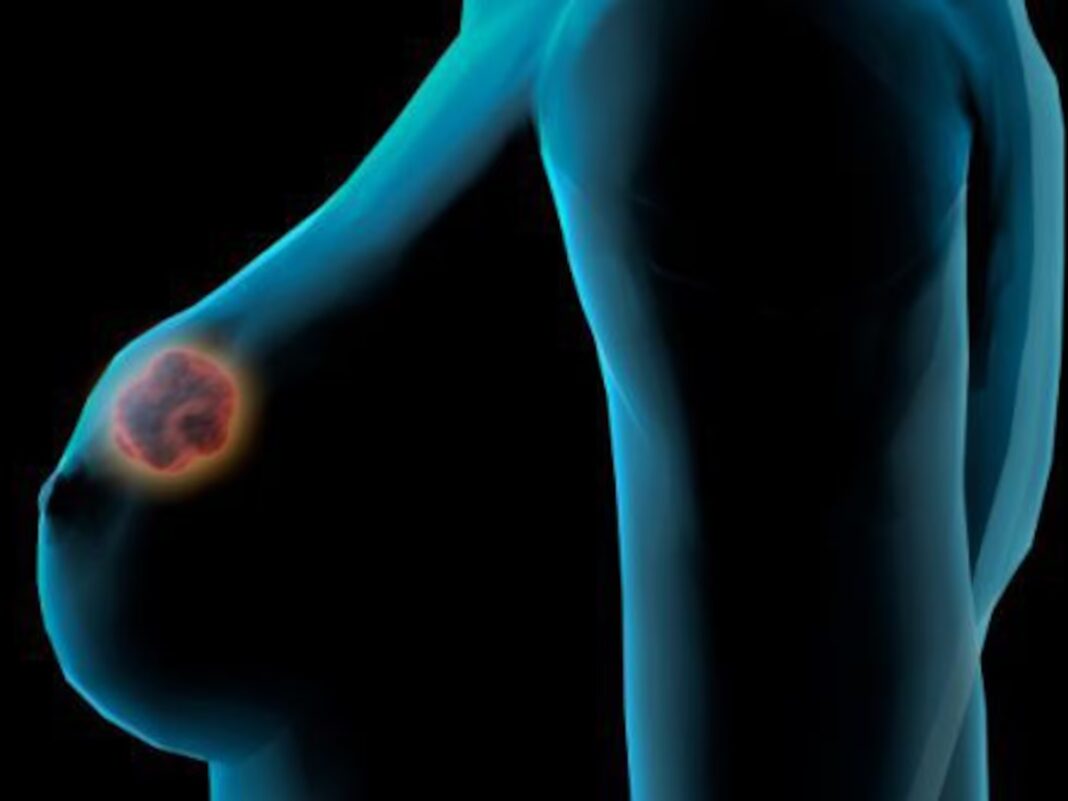 Alertan de retrasos evitables en el cribado de cáncer de mama